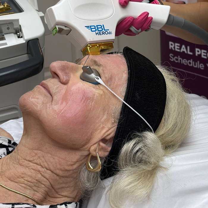 BBL HEROic® treatment