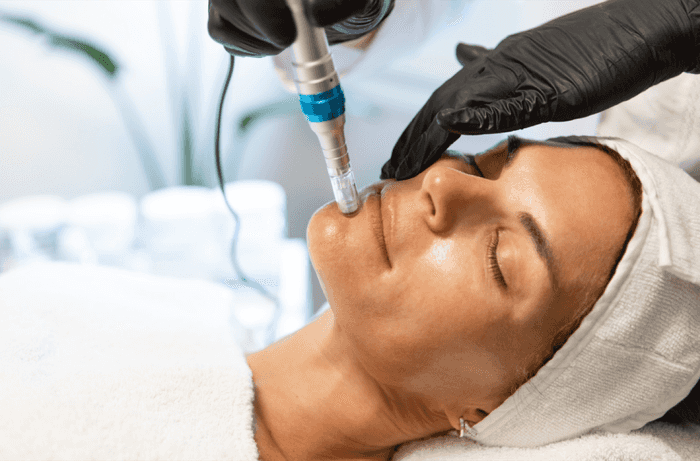 Microneedling with Skin Boosters