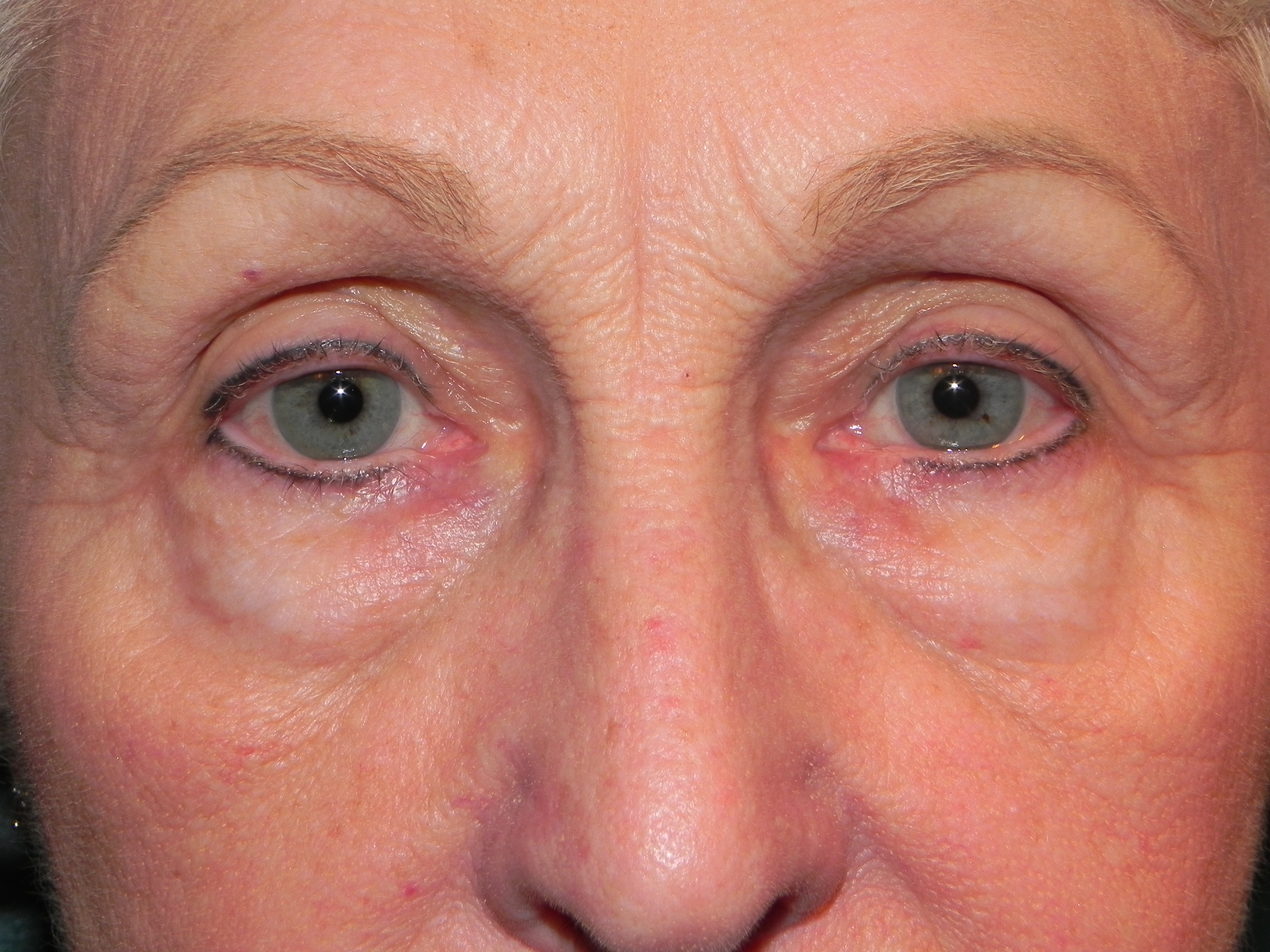 Puffy Eyes Dark Circles and Bags Dermatologists Explain the Difference   SELF