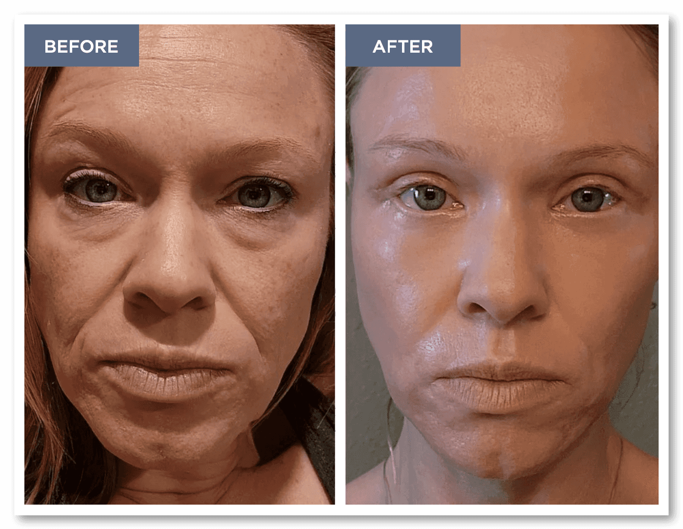 A stunning before and after of Angie showing the power of the RESET ® Full Face Resurfacing.