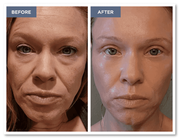 Stunning before and after showing the transformative power fo the reset procedure. The before image has deep lines, heavy eye bags, and a worn appearance. The after image has erased the lines and eye bags while giving the face a brighter, more youthful appearance.