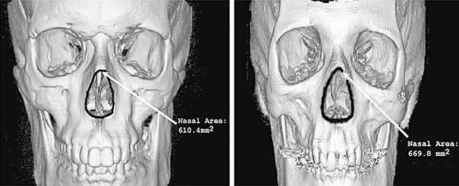 Increase in the open of the skeleton around the nose