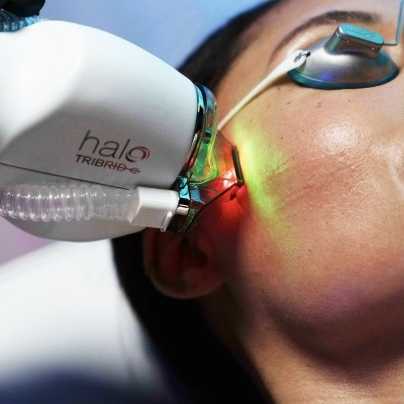 HALO TRIBRID™ treatment