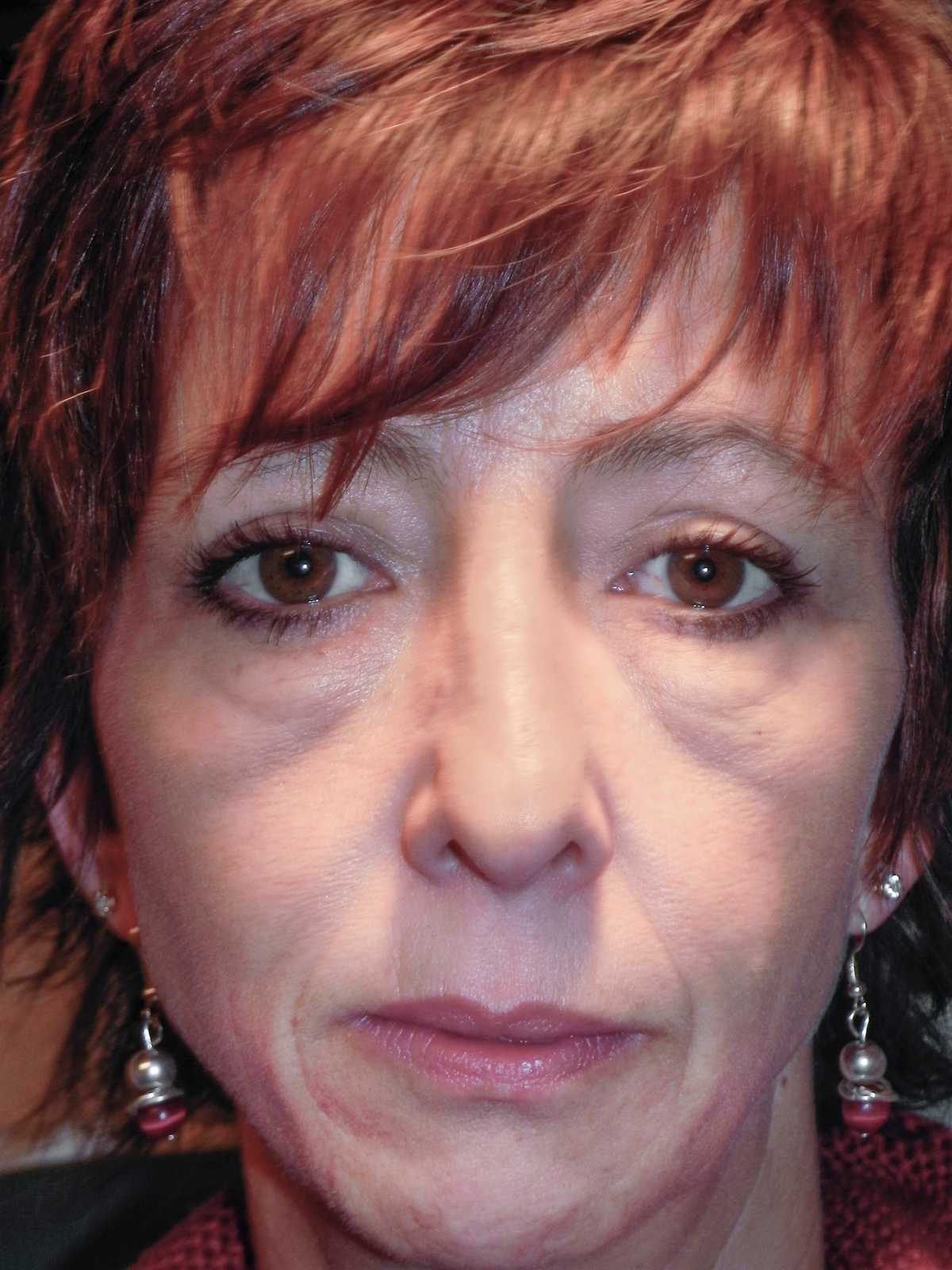 RESET® for Festoons Adam Scheiner MD Dr. Adam Scheiner