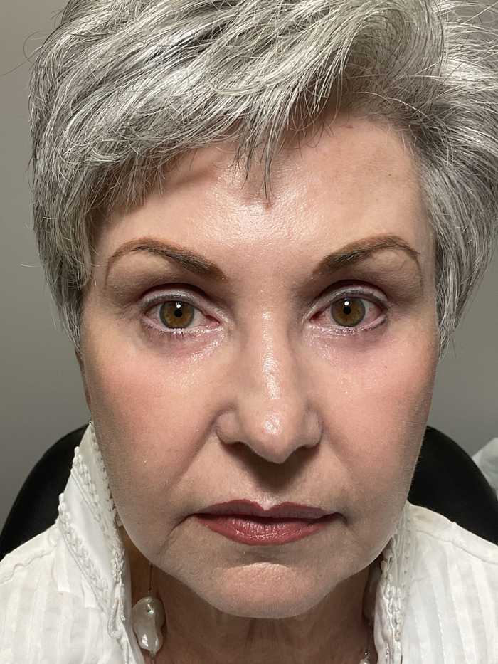 Patient after The Better Blepharoplsty