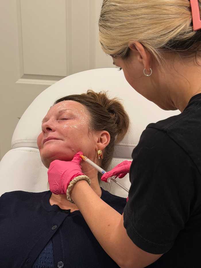 RadiantLift filler treatment