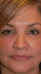 woman after surgery to remove eye festoons