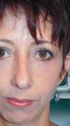 woman after festoon surgery