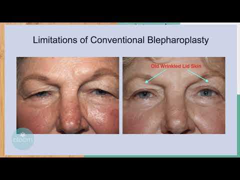 What is the Better Blepharoplasty : WFLA BLOOM