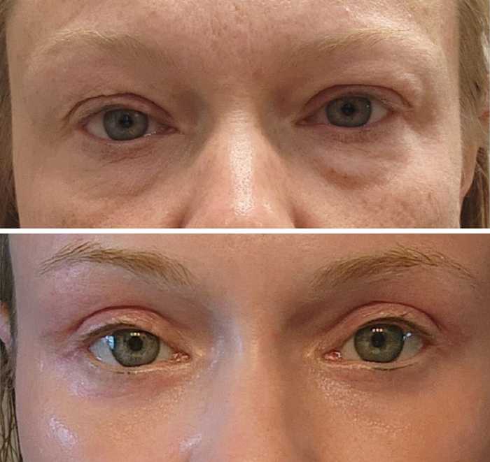 A close up of Angie's eyes showing a before (above) and after (below).